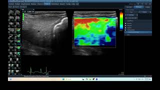 IQ 277 LIVER ELASTOGRAPHY HEPATOMA ECHOPAC ANALYSIS ULTRASOUND [upl. by Morse]