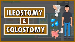 Ileostomy and Colostomy  Emphasis on DietNutrition [upl. by Fabrienne698]