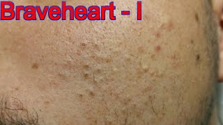 Extraction for Teenage Acne  Part 1 of 3 [upl. by Ahtnams420]