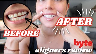 BYTE ALIGNERS REVIEW  progress  byte aligners before amp after [upl. by Solhcin]