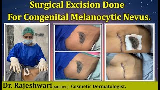 Surgical Excision Done For Congenital Melanocytic Nevus [upl. by Cho]