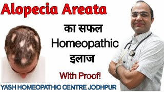 Alopecia Areata treatment  hair loss treatment  baldness best treatment बाल झड़ने का तेल ईलाज [upl. by Ryter]