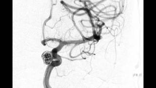 Neurointerventional Stroke Rounds  Aneurysm Coiling [upl. by Ingemar]