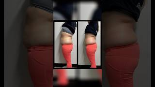 Results of cryoslimming cryotherapy cryoslimming cryotherapist [upl. by Eibmab298]