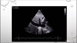 2712 echo conference constrictive pericarditis [upl. by Dovev]