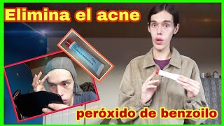 Como usar el Peróxido de Benzoilo para Quitar el Acne [upl. by Kamp811]