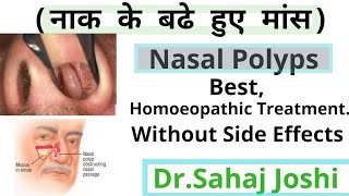 Homoeopathic Medicine For Nasal Polypsनाक के बढे हुए मांस [upl. by Goober237]