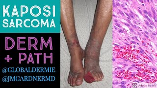 Kaposi Sarcoma DermatologyPathology Collaboration by globaldermie amp JMGardnerMD [upl. by Sheedy]