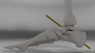 Over Pronation amp Supination Motion Biomechanics of the Subtalar Joint Explained [upl. by Nodle]