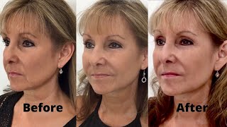 How to Get Rid of Jowls with Dermal Fillers Step 3 [upl. by Nine226]