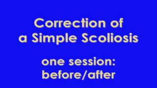 Scoliosis correction by Hanna Somatic Education  see description [upl. by Aniluj]