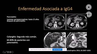 Radiología en 5 minutos Enfermedad asociada a IgG4 [upl. by Merfe]