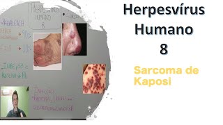 Herpesvírus Humano 8 associado ao sarcoma de Kaposi  Curso de virologia  Medicina passo a passo [upl. by Chiarra]