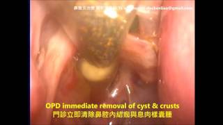 鼻竇炎治療 息肉樣囊腫 RHINOSINUSITIS immediate removal of nasal polypoid cyst post FESS [upl. by Mendy]