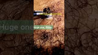 Huge Blackheads Extraction Big Cystic Pimple BlackheadsampWhiteheads Removal Popping 43 Shorts [upl. by Ladonna]