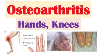 Osteoarthritis Arthritis of Hands Knees  Causes Risk Factors Symptoms Diagnosis Treatment [upl. by Annahs]