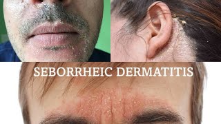 Seborrheic dermatitis  treatment health [upl. by Noslen]