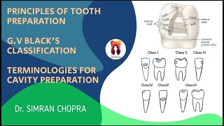 Principles for Tooth Preparation l GV Blacks Classification l Operative Dentistry [upl. by Soalokin]