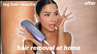 I TRIED LASER HAIR REMOVAL AT HOME this is what happened [upl. by Asiul665]