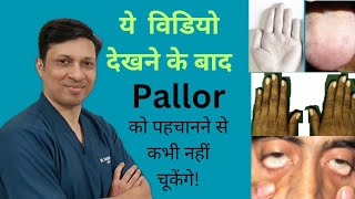 Pallor ExaminationPallor meaningPallor grading in hindi [upl. by Campney]