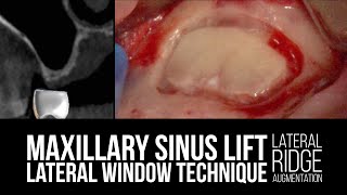 Maxillary Sinus Lift with Lateral Window Technique with Lateral Ridge Augmentation [upl. by Sremmus]