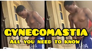 ALL YOU NEED TO KNOW ABOUT GYNECOMASTIA ytaids [upl. by Cloe]