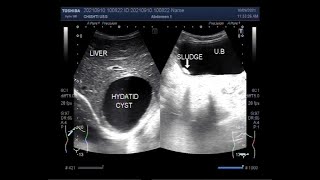 Hepatic Hydatid Cyst [upl. by Allis22]