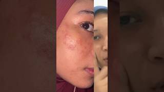 Dermatitis Perioral My experience 20232024 skincare dermatitis skimcarelokal [upl. by Zelde]