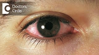 How to manage swollen amp sensitive eyes after injury  Dr Elankumaran P [upl. by Aimak]