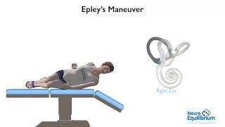 Epley Maneuver A Step by Step Guide to Treat BPPV Vertigo [upl. by Ramyar]