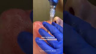 Natural Collagen Booster Treatment  Exosome Therapy  Dr Kami Parsa amp Associates [upl. by Atla405]