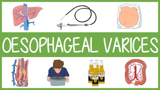 Oesophageal Varices [upl. by Scrope]