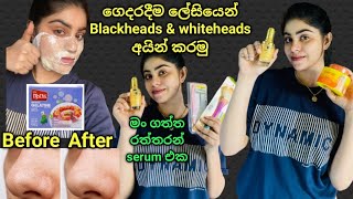 අඩු මුදලකින් ගෙදරදීම White heads amp Black heads අයින් කරගමු 😍  රන්වන් සමක් දෙන 24K Gold Serum 🥰 [upl. by Irrep]