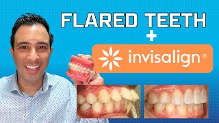 Invisalign Magic to Fix Flared Teeth WITHOUT EXTRACTION by Dr Robert Passamano [upl. by Tufts200]