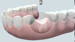 Cómo se coloca un implante dental [upl. by Econah698]