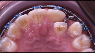 Double wire technique in orthodontic piggy back correcting cross bite [upl. by Ilrebmik]