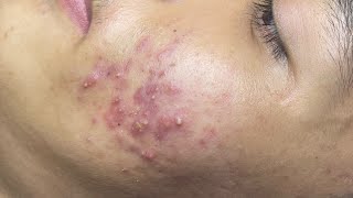 ACNE TREATMENT VU QUYNH MI  Perennial Blackheads On Boy Face 2024FULL [upl. by Teeniv951]