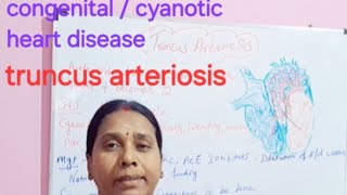 congenitalcyanotic heart disease truncus arteriosis [upl. by Charin]