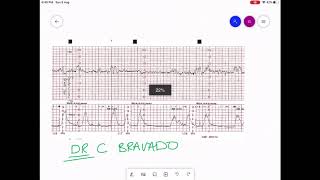 CARDIOTOCOGRAPHY  CTG INTERPRETATION [upl. by Ahseuqal]