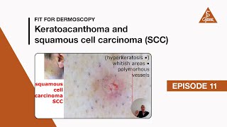 Fit for Dermoscopy Episode 11  Keratoacanthoma and Squamous Cell Carcinoma SCC [upl. by Ennagrom]