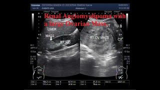 Renal Angiomyolipoma with a large Ovarian Mass [upl. by Dira]