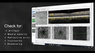 Systematic Interpretation of OCT Angiography Images [upl. by Verdha]