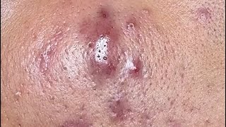 CloseUp Blackhead Removal Watch Every Pore Get Cleansed [upl. by Laban]