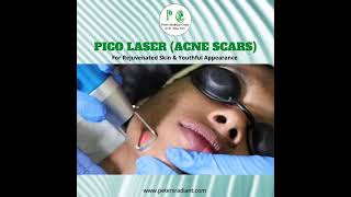 Pico Laser for Pigmentation amp Acne Scar [upl. by Hedges285]