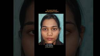 RHINOPLASTY SURGERY HYDERABAD BANGALORE VISAKHAPATNAM WARANGAL GUNTUR KHAMMAM TIRUPATI KARIMNAGAR [upl. by Cartie]