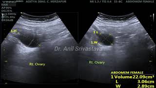 MUCINOUS CYSTADENOMA OVARY [upl. by Robina]