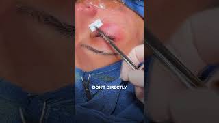 lower lid blepharoplasty with fat repositioning [upl. by Gerc381]