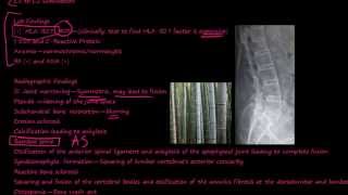 97P What is Ankylosing Spondylitis [upl. by Nahc]