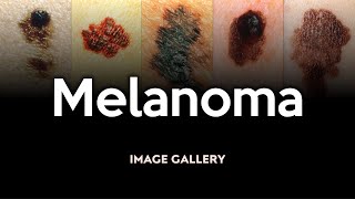 Melanoma Image Gallery [upl. by Jaquelin]