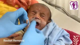 Rocket Removed From This Kids Nose After General Anesthesia [upl. by Barren]